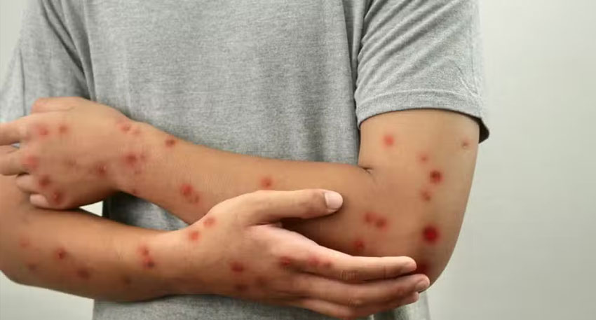 Pakistan confirms first monkeypox case in Lahore